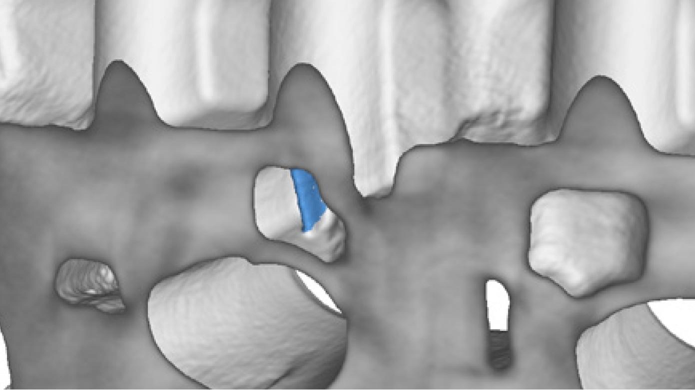 ZEISS Leichtmetall Kernbruch