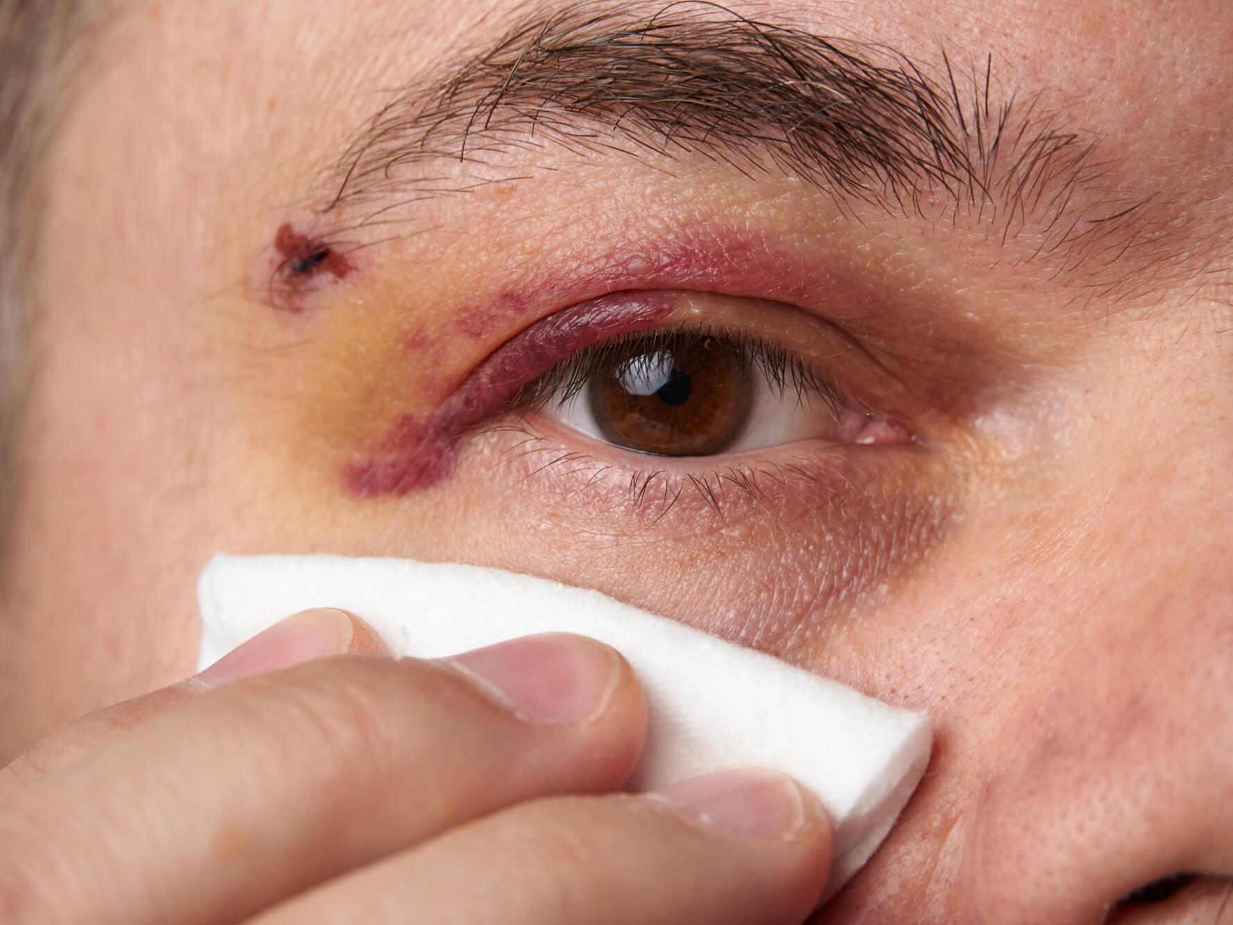Das Anwenden einer kalten Kompresse auf die Augenpartie kurz nach einer Verletzung kann Schwellungen reduzieren und Schmerzen lindern.