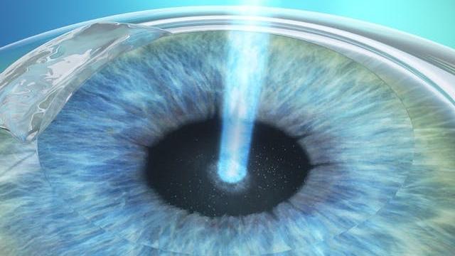 Reshaping the cornea