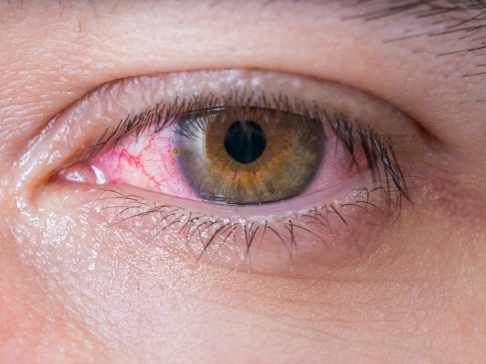 Die Abbildung zeigt eine Nahaufnahme eines erkrankten Auges und veranschaulicht mögliche Gefahren. 
